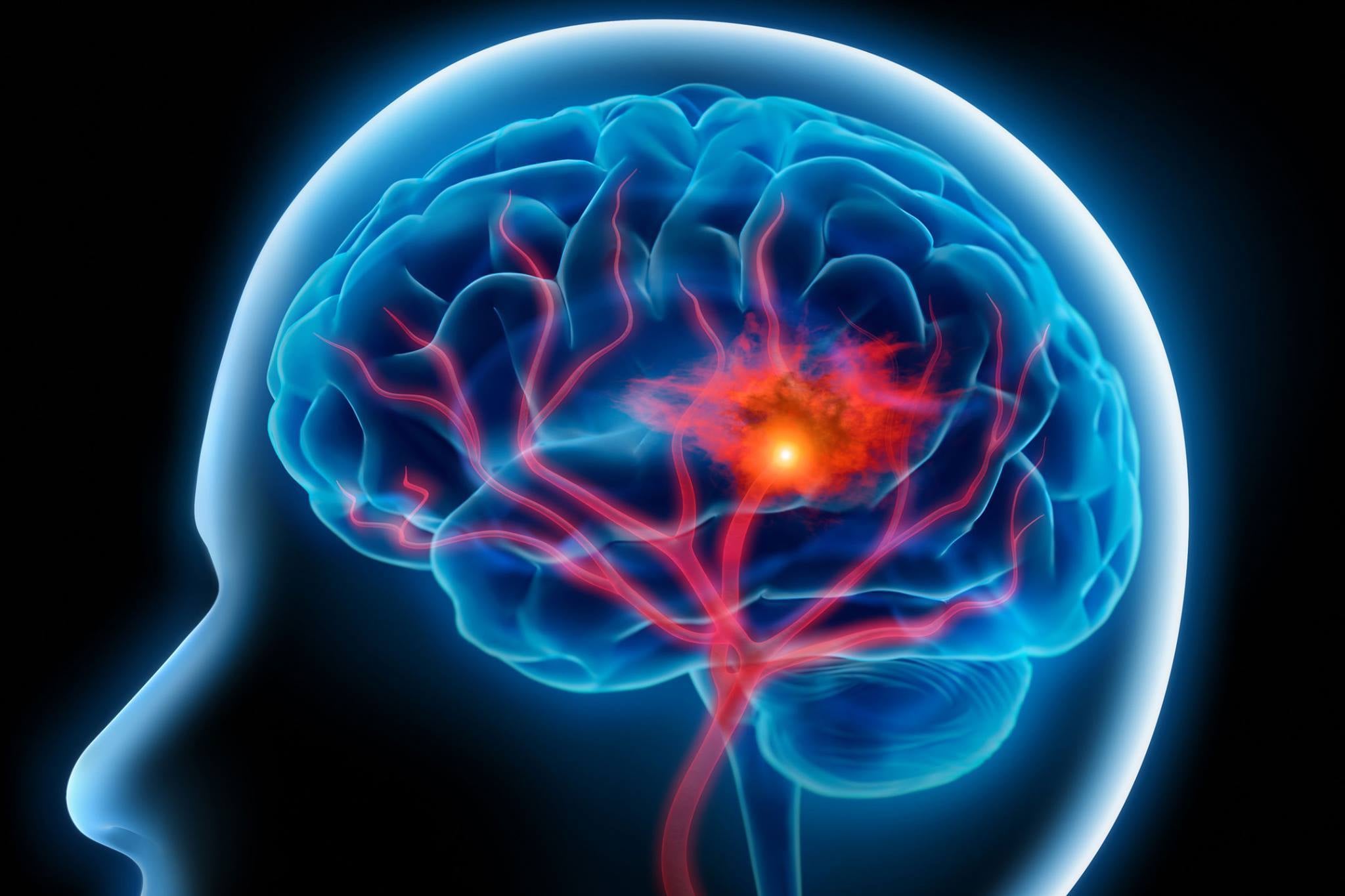 Dia Mundial do AVC: Um Alerta para a Saúde Cerebral